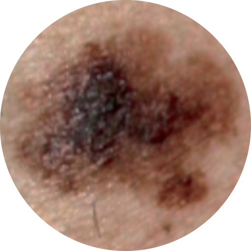 B=BORDER:When the borders of the mole are irregular/ragged or blurred